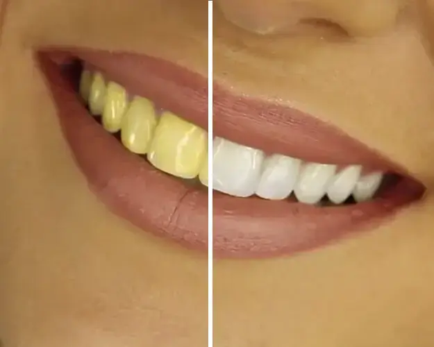 KöR Whitening
